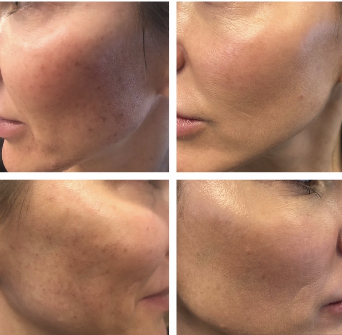 Laser Skin Resurfacing In Brecksville Radiant Divine Medical Spa