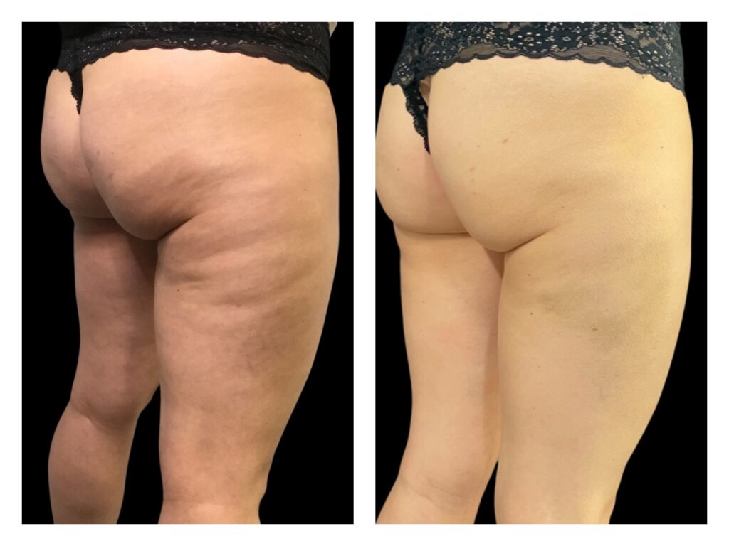 What Causes Cellulite and How Do You Treat It? - Jeune Ascot Vale