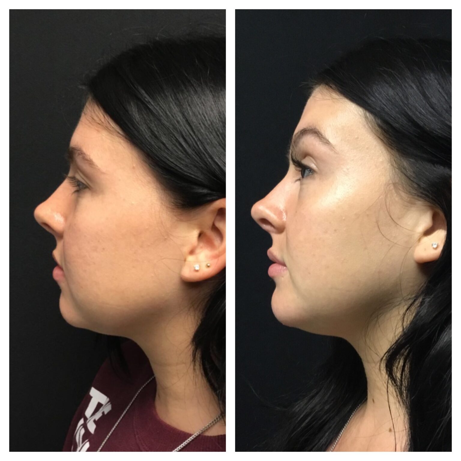 Jawline Filler 1 - Radiant Divine Medical Spa