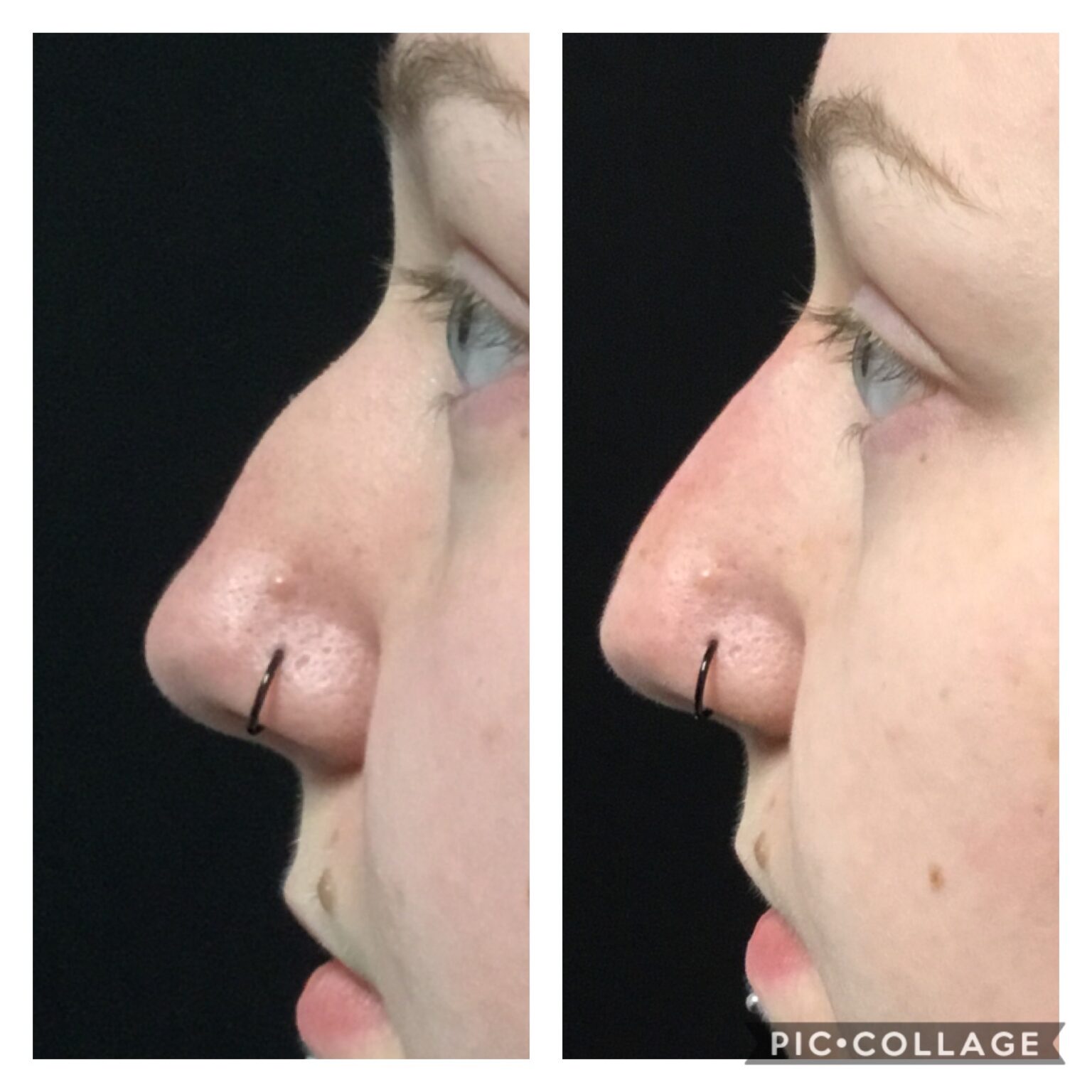 Liquid Nose Job 3 - Radiant Divine Medical Spa