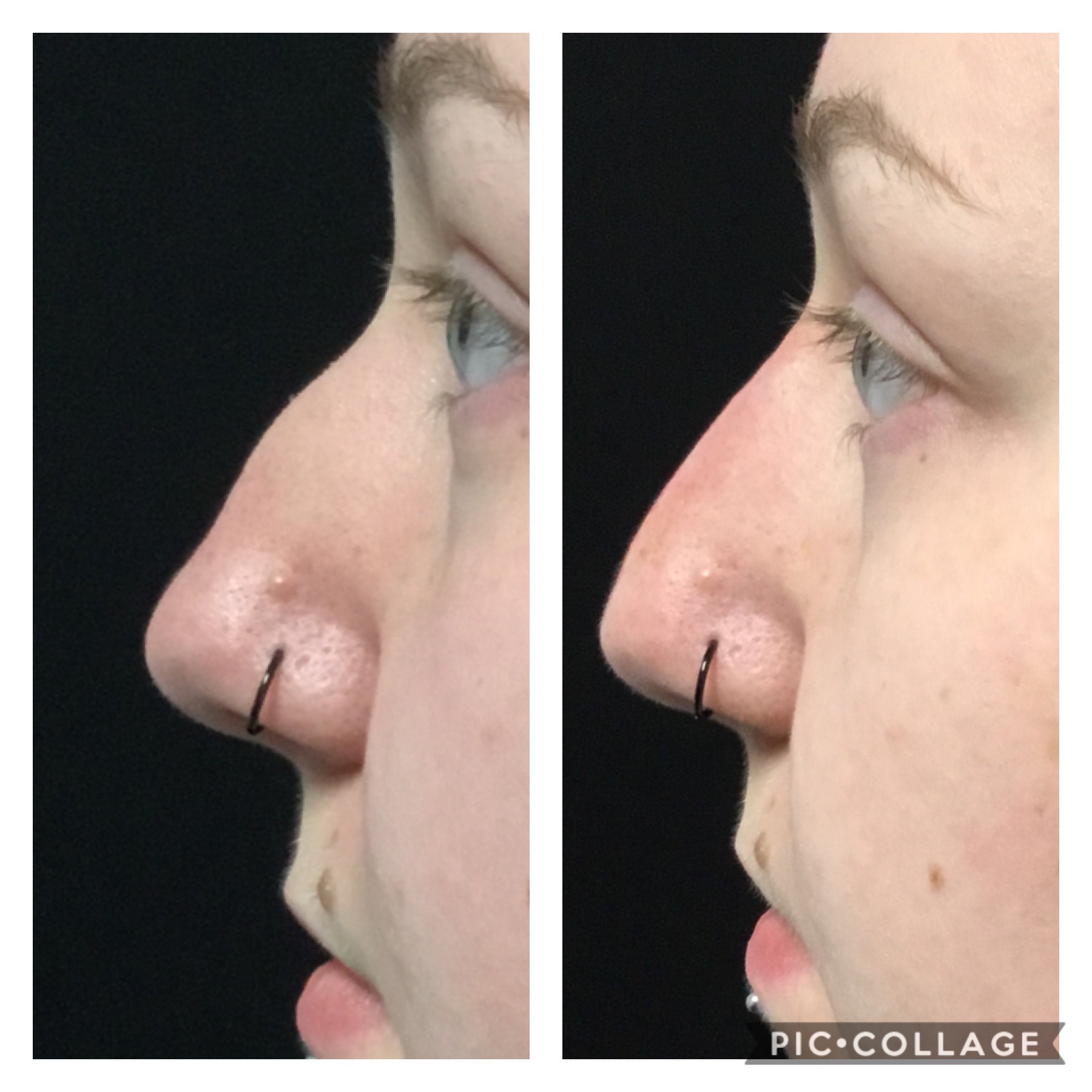 Liquid Nose Job Near Me Find the Perfect Non-Invasive Solution
