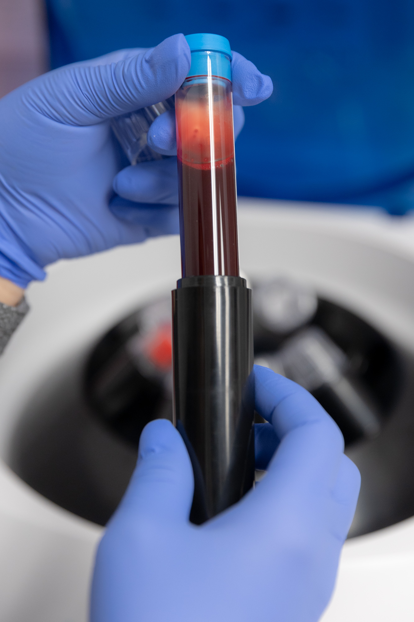 medical provider holds a vial of blood for spinning in centrifuge for prf or prp