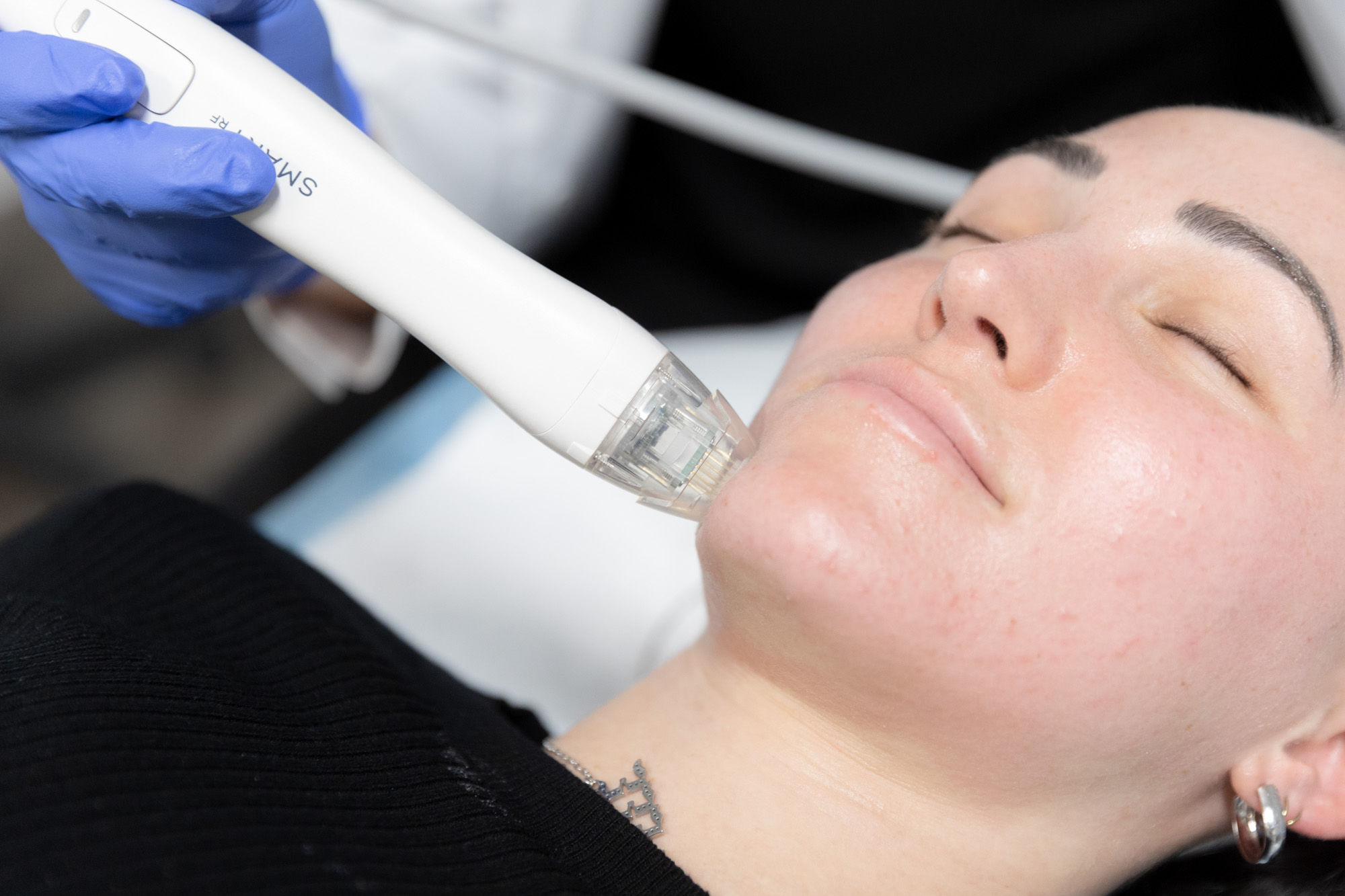 A woman receives an RF microneedling treatment